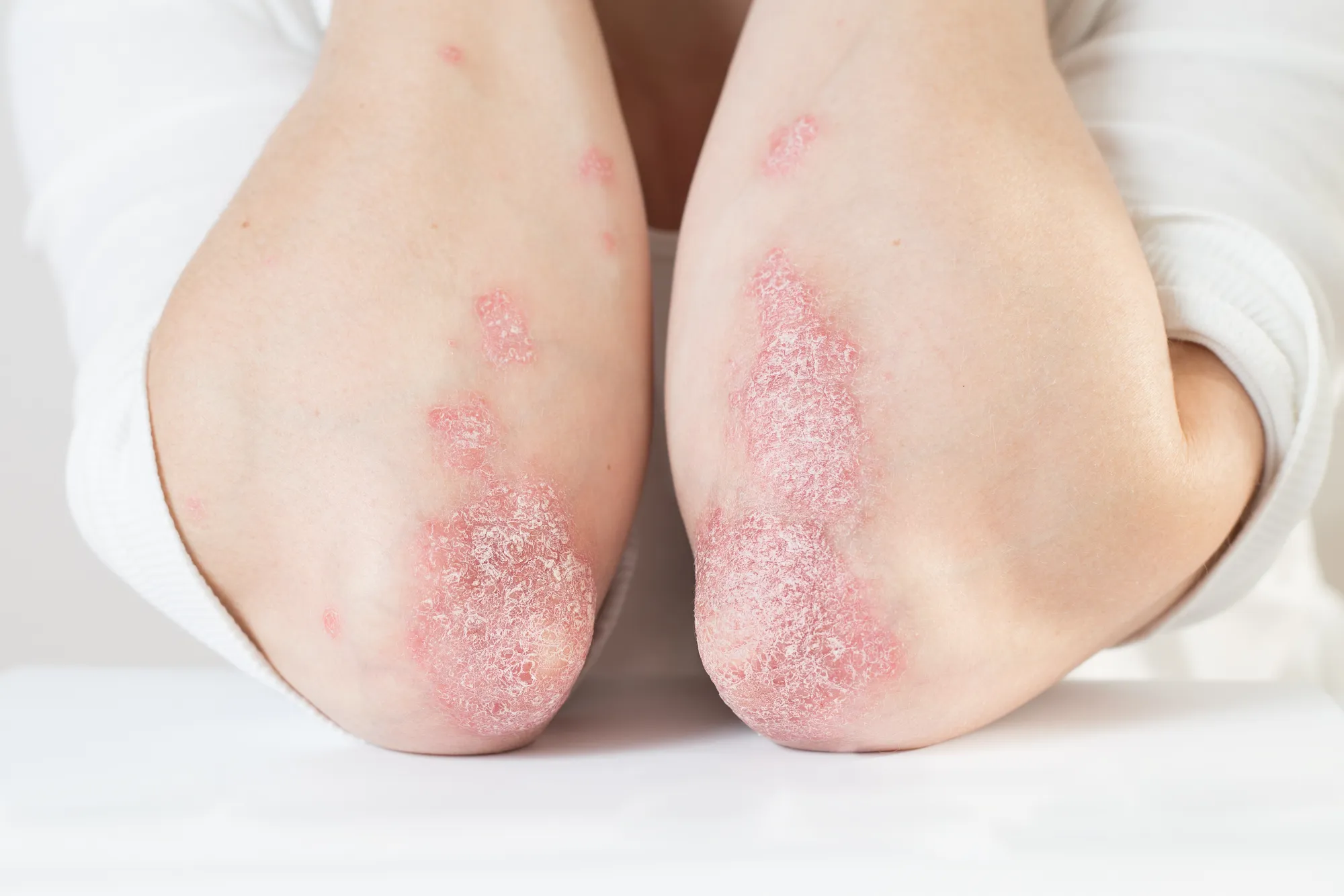 enfermedad-psoriasis-foro-piel