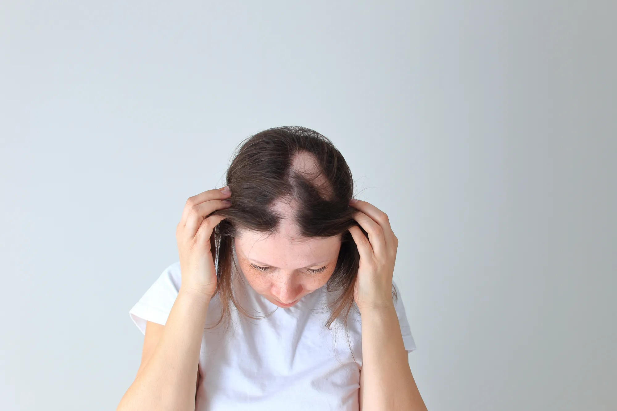 Alopecia Areata-foro piel Vitiligo- foro piel