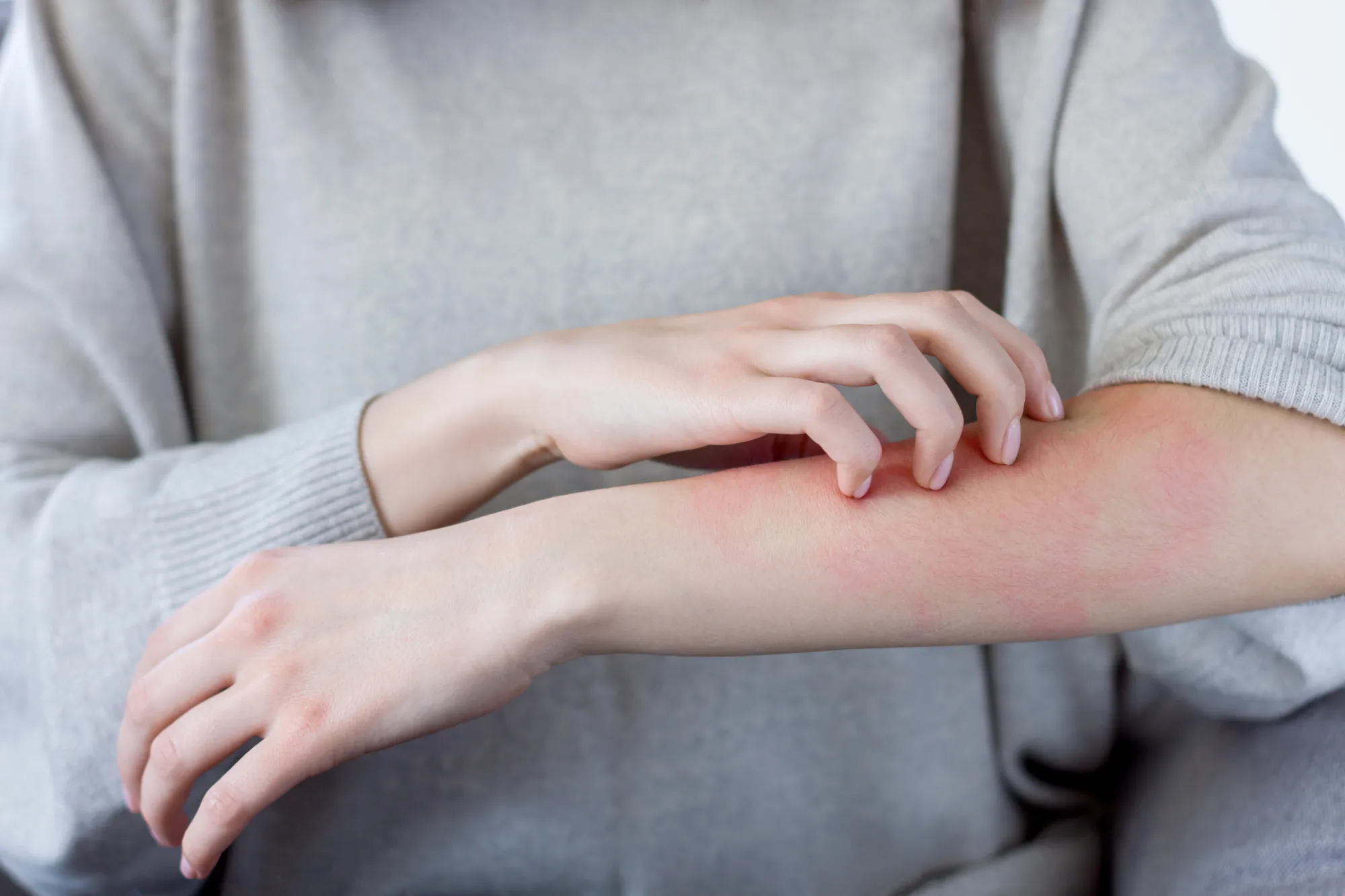 Dermatits atópica-foro-piel Vitiligo- foro piel