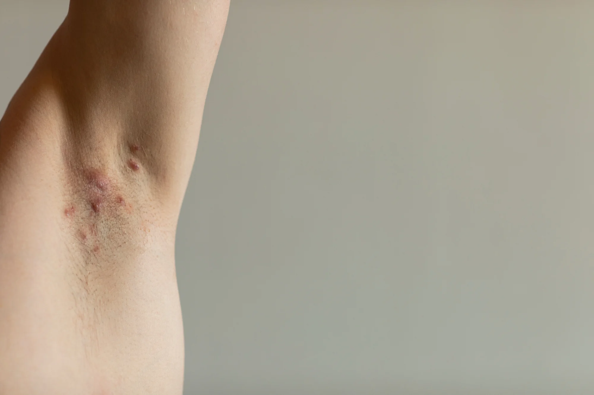 Vitiligo- foro piel