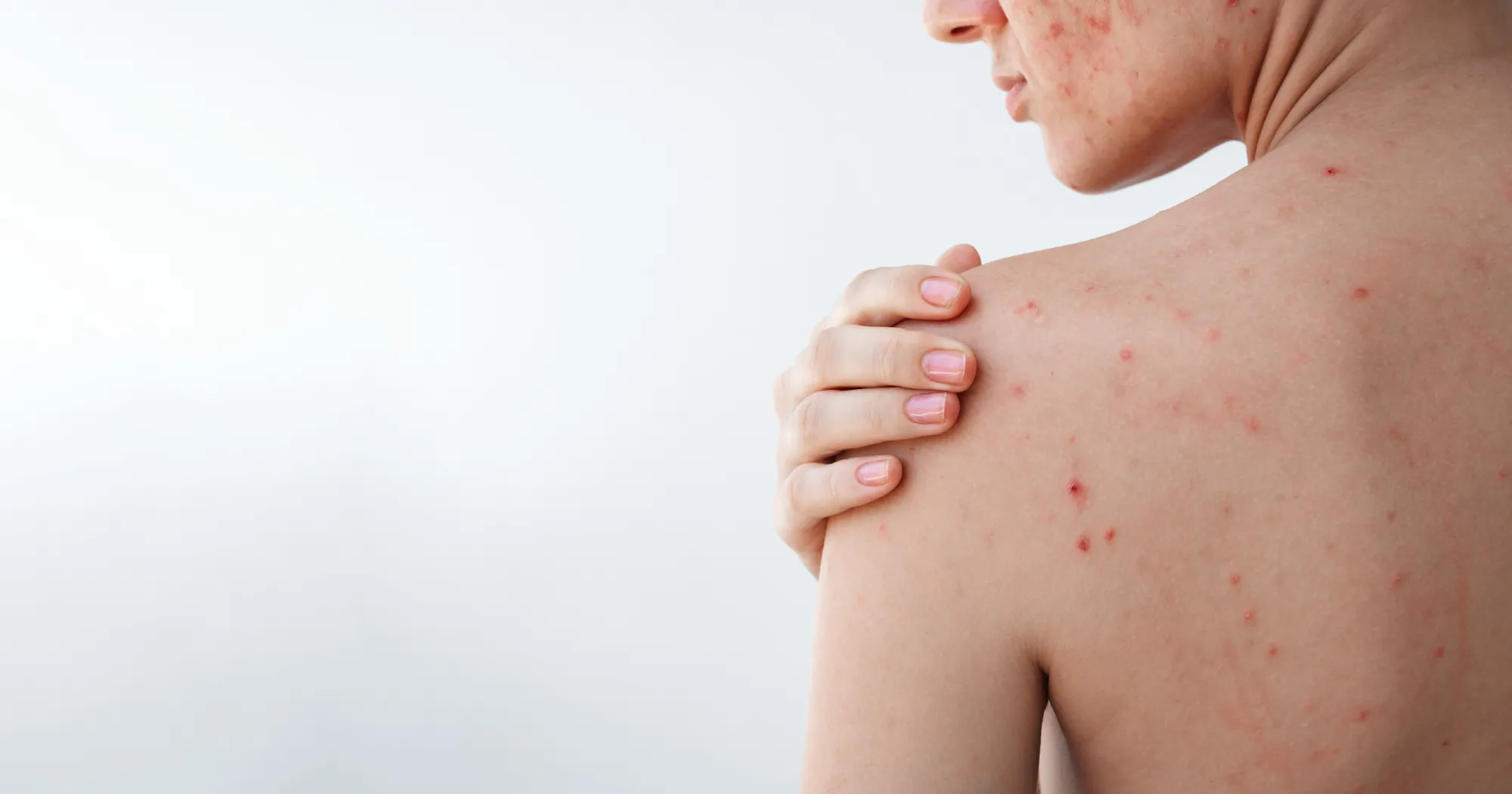 acne Vitiligo- foro piel