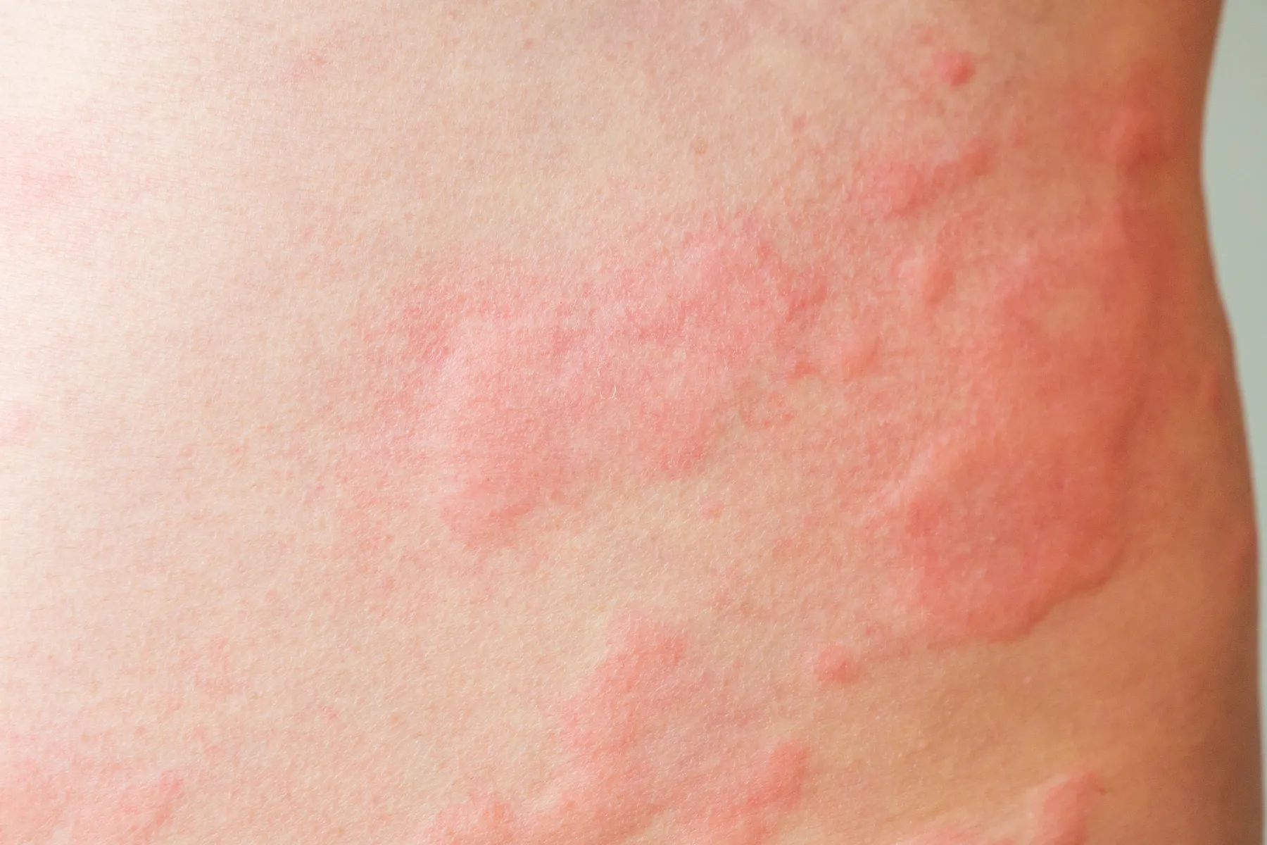Vitiligo- foro piel